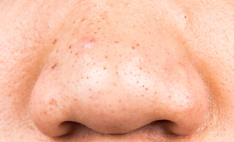 鼻子的黑头怎么去除？徹底清潔與保養全攻略