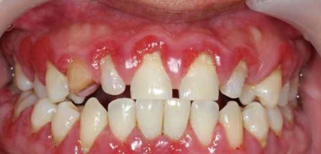 造成牙齦萎縮的原因