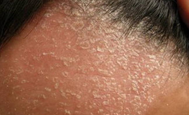 頭皮紅紅的不癢