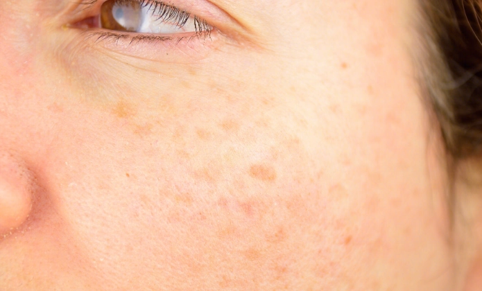 臉上黑斑如何去除