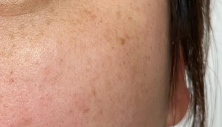 快速去斑的方法