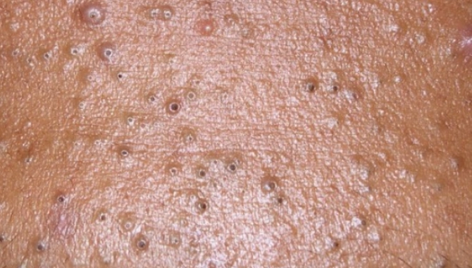 內包粉刺會自己代謝嗎