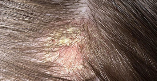 頭皮顏色不一樣