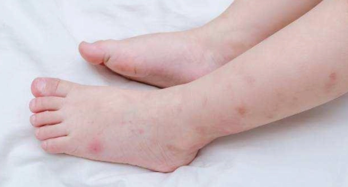 小孩蚊子叮止癢