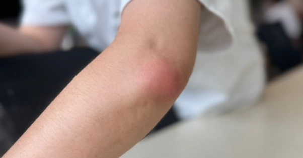 為什麼被蚊子叮會癢很久