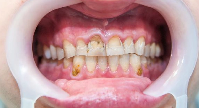 如何消除牙齦腫