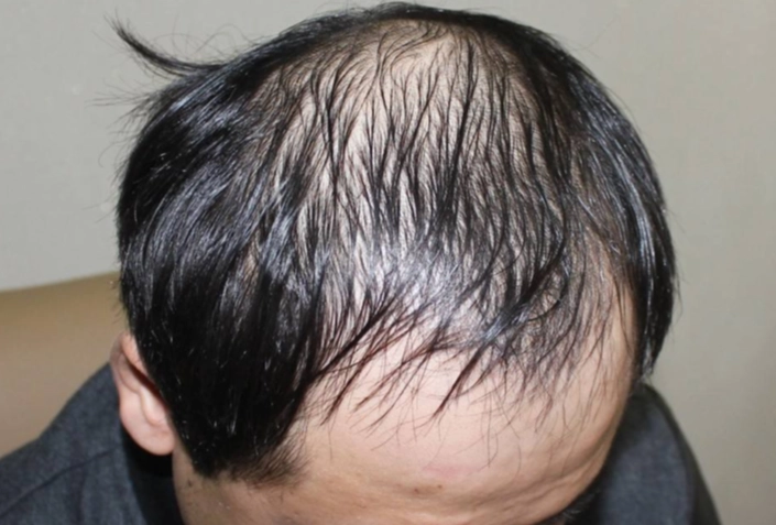 男士脫髮先兆