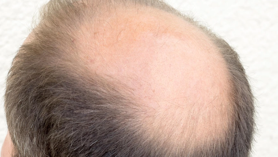 雄性禿 改善