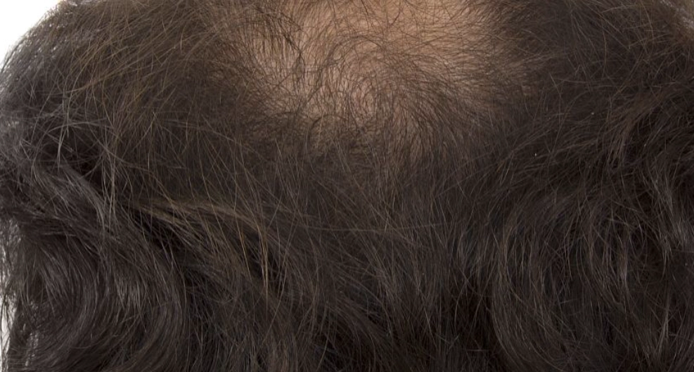 一天長幾根頭髮