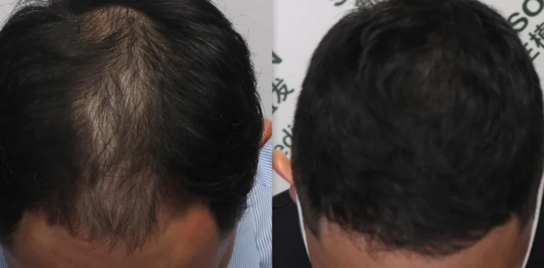 頭頂髮量少怎麼辦