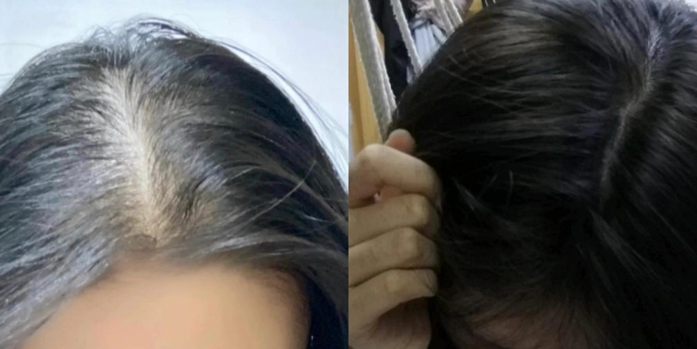 髮量少看到頭皮女怎麼辦？5個實用改善方法與專家建議